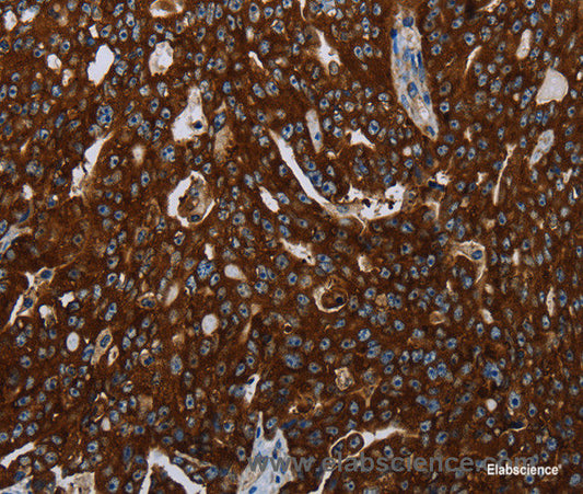 Immunohistochemistry of paraffin-embedded Human ovarian cancer tissue using KISS1R Polyclonal Antibody at dilution 1:30