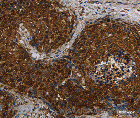 Immunohistochemistry of paraffin-embedded Human cervical cancer tissue using CERS5 Polyclonal Antibody at dilution 1:40
