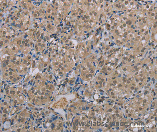 Immunohistochemistry of paraffin-embedded Human thyroid cancer tissue using MGLL Polyclonal Antibody at dilution 1:40