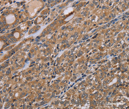 Immunohistochemistry of paraffin-embedded Human thyroid cancer tissue using NAA25 Polyclonal Antibody at dilution 1:40