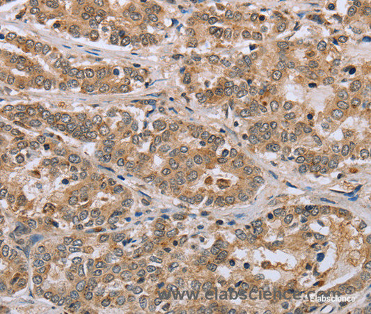 Immunohistochemistry of paraffin-embedded Human liver cancer tissue using CLEC16A Polyclonal Antibody at dilution 1:45