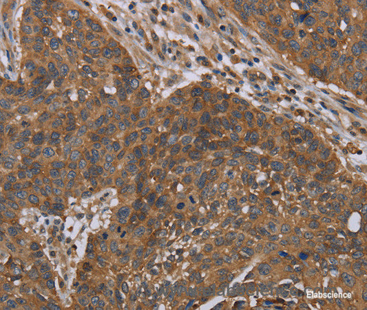 Immunohistochemistry of paraffin-embedded Human lung cancer tissue using OXTR Polyclonal Antibody at dilution 1:40