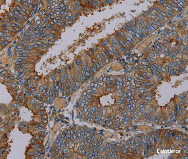Immunohistochemistry of paraffin-embedded Human colon cancer tissue using PYY Polyclonal Antibody at dilution 1:30