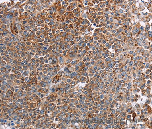 Immunohistochemistry of paraffin-embedded Human ovarian cancer tissue using PLXNA2 Polyclonal Antibody at dilution 1:40