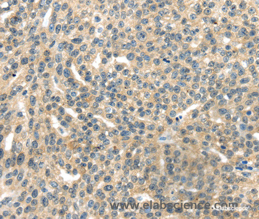 Immunohistochemistry of paraffin-embedded Human esophagus cancer tissue using RASA2 Polyclonal Antibody at dilution 1:45