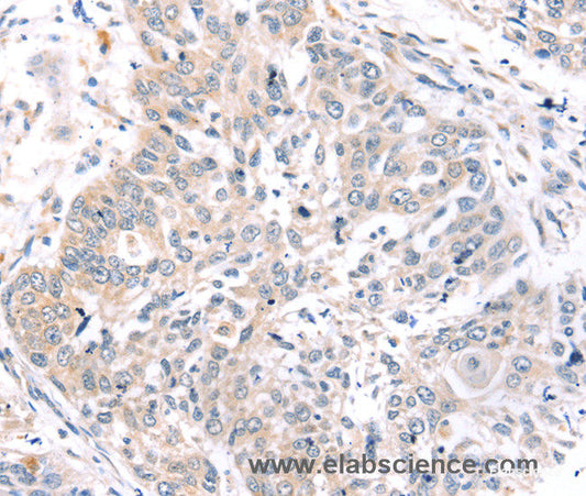 Immunohistochemistry of paraffin-embedded Human lung cancer tissue using ROR1 Polyclonal Antibody at dilution 1:45