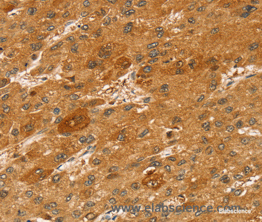 Immunohistochemistry of paraffin-embedded Human liver cancer tissue using STX2 Polyclonal Antibody at dilution 1:50