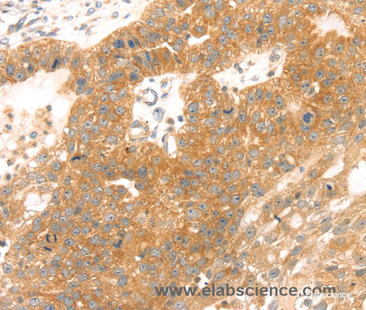 Immunohistochemistry of paraffin-embedded Human breast cancer tissue using TMEFF2 Polyclonal Antibody at dilution 1:35