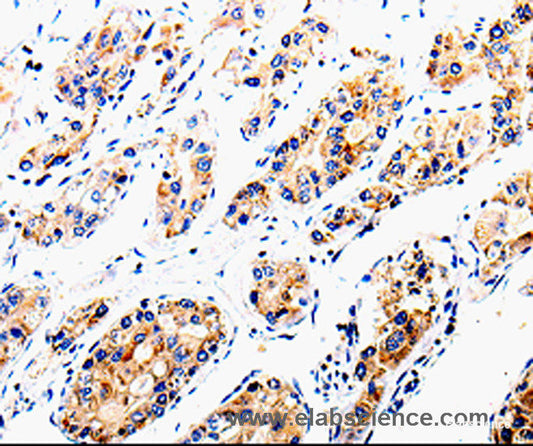 Immunohistochemistry of paraffin-embedded Human liver cancer tissue using COX16 Polyclonal Antibody at dilution 1:50