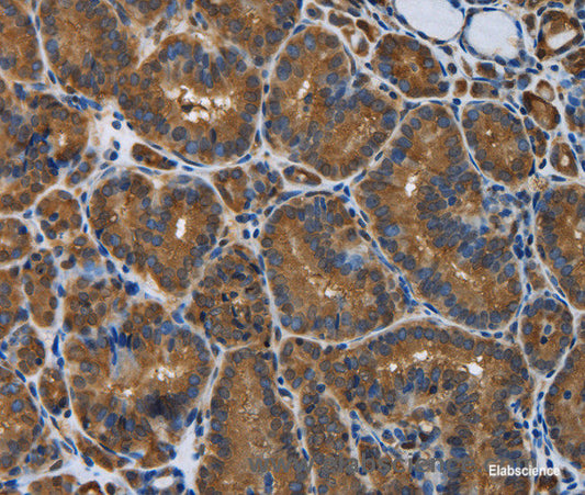 Immunohistochemistry of paraffin-embedded Human thyroid cancer tissue using SNCG Polyclonal Antibody at dilution 1:50