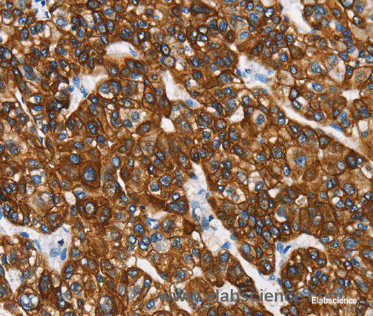 Immunohistochemistry of paraffin-embedded Human liver cancer tissue using CK-8 Polyclonal Antibody at dilution 1:40