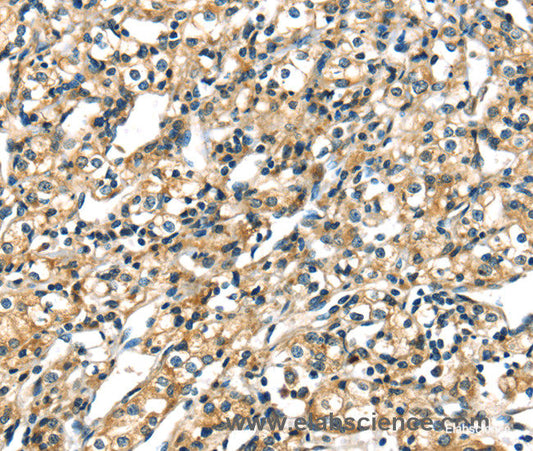 Immunohistochemistry of paraffin-embedded Human prostate cancer tissue using CK-17 Polyclonal Antibody at dilution 1:40