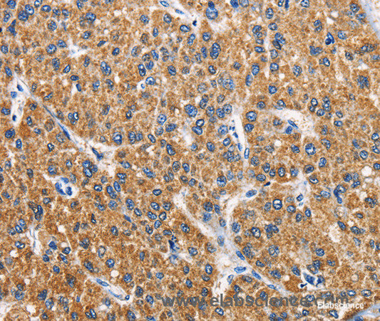 Immunohistochemistry of paraffin-embedded Human liver cancer tissue using APLNR Polyclonal Antibody at dilution 1:40