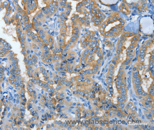 Immunohistochemistry of paraffin-embedded Human thyroid cancer tissue using MUC15 Polyclonal Antibody at dilution 1:50