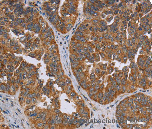 Immunohistochemistry of paraffin-embedded Human ovarian cancer tissue using ADAMTS15 Polyclonal Antibody at dilution 1:60