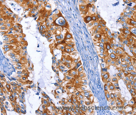 Immunohistochemistry of paraffin-embedded Human cervical cancer tissue using ARRB1 Polyclonal Antibody at dilution 1:50