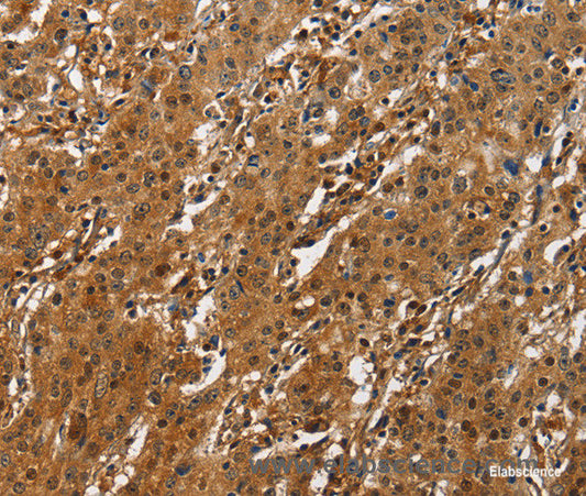 Immunohistochemistry of paraffin-embedded Human gasrtic cancer tissue using CREB2 Polyclonal Antibody at dilution 1:50