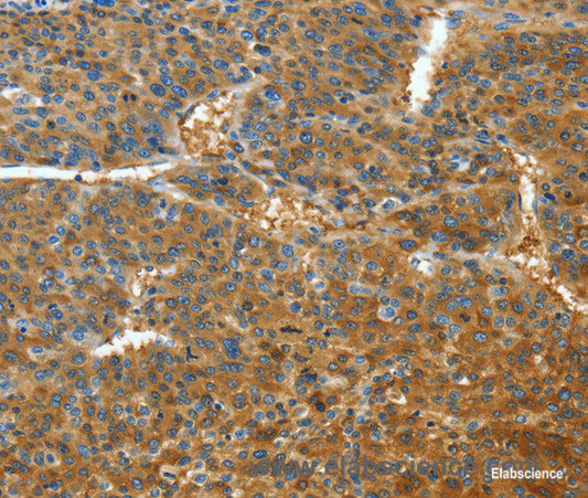 Immunohistochemistry of paraffin-embedded Human liver cancer tissue using TNFSF13B Polyclonal Antibody at dilution 1:30