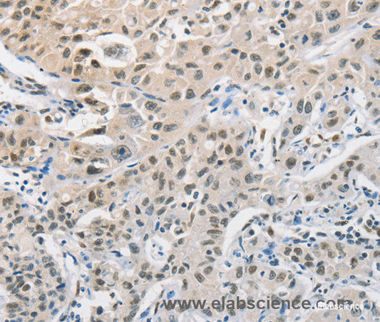Immunohistochemistry of paraffin-embedded Human lung cancer tissue using CDC27 Polyclonal Antibody at dilution 1:50