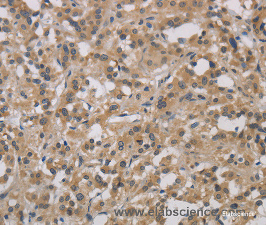 Immunohistochemistry of paraffin-embedded Human thyroid cancer tissue using DCN Polyclonal Antibody at dilution 1:30