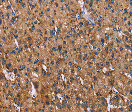 Immunohistochemistry of paraffin-embedded Human liver cancer tissue using CD107b Polyclonal Antibody at dilution 1:30