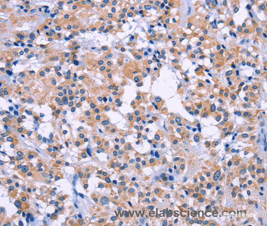 Immunohistochemistry of paraffin-embedded Human thyroid cancer tissue using DUSP22 Polyclonal Antibody at dilution 1:60