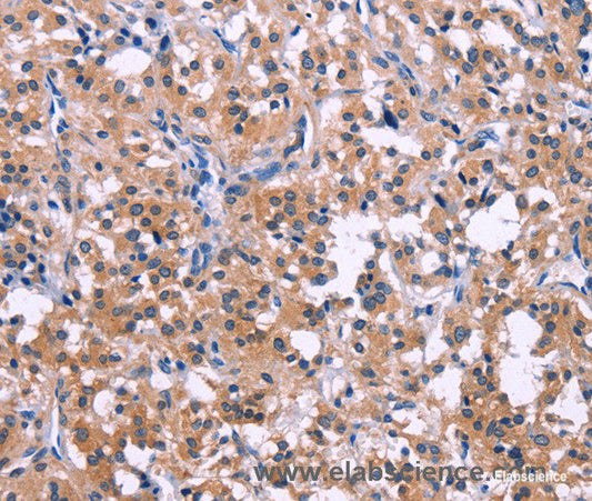 Immunohistochemistry of paraffin-embedded Human thyroid cancer tissue using DUSP13 Polyclonal Antibody at dilution 1:50