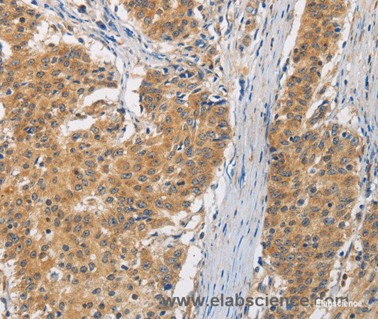 Immunohistochemistry of paraffin-embedded Human gasrtic cancer tissue using FASTK Polyclonal Antibody at dilution 1:30