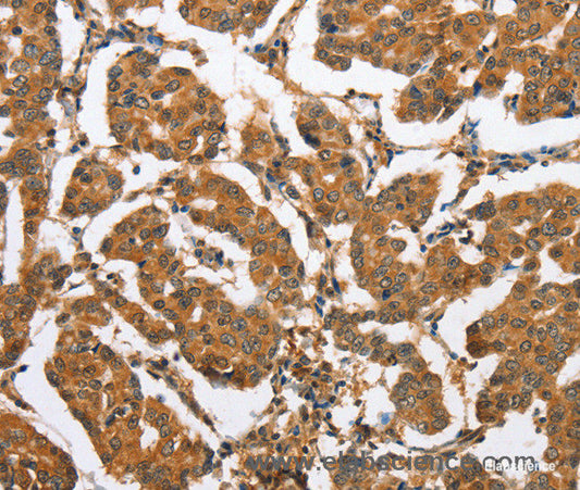 Immunohistochemistry of paraffin-embedded Human breast cancer tissue using CXCL14 Polyclonal Antibody at dilution 1:60