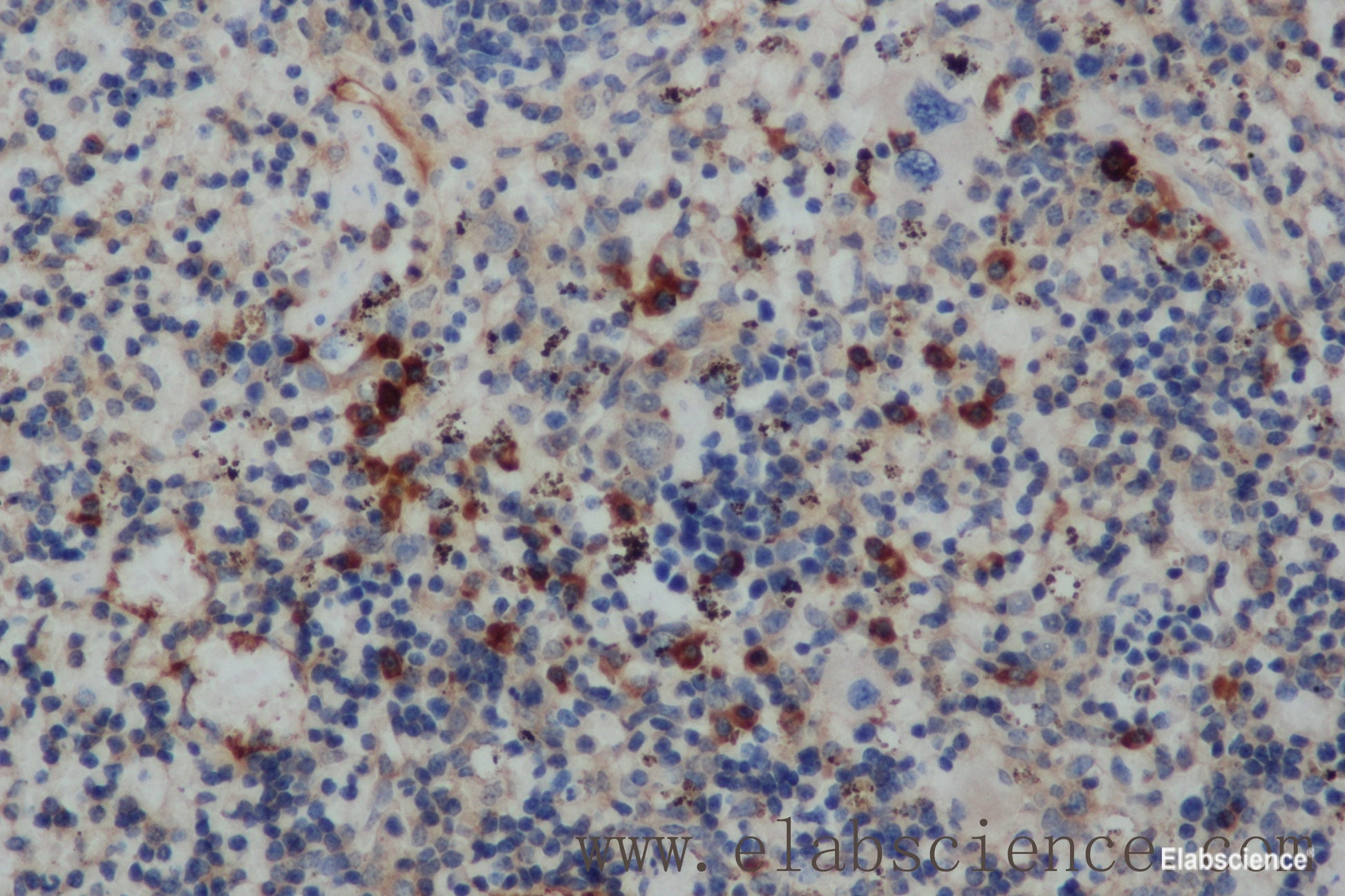Immunohistochemistry of paraffin-embedded Human cervical cancer tissue using IFNG Polyclonal Antibody at dilution 1:30