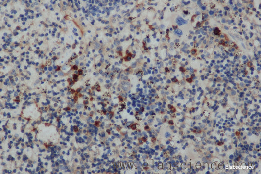 Immunohistochemistry of paraffin-embedded Human cervical cancer tissue using IFNG Polyclonal Antibody at dilution 1:30