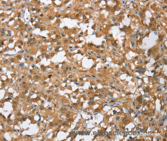 Immunohistochemistry of paraffin-embedded Human thyroid cancer tissue using MMP12 Polyclonal Antibody at dilution of 1:60