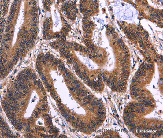 Immunohistochemistry of paraffin-embedded Human colon cancer tissue using MSH4 Polyclonal Antibody at dilution 1:50