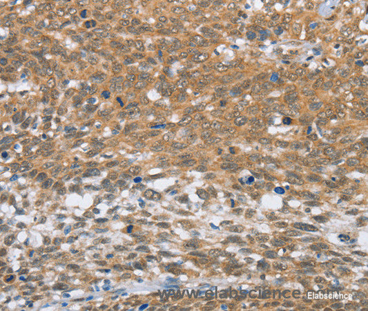 Immunohistochemistry of paraffin-embedded Human cervical cancer tissue using MLH1 Polyclonal Antibody at dilution 1:60