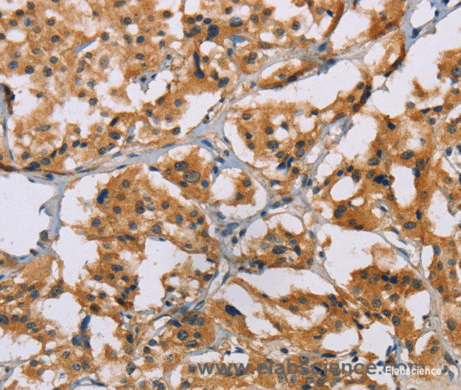 Immunohistochemistry of paraffin-embedded Human thyroid cancer tissue using NRN1 Polyclonal Antibody at dilution of 1:50