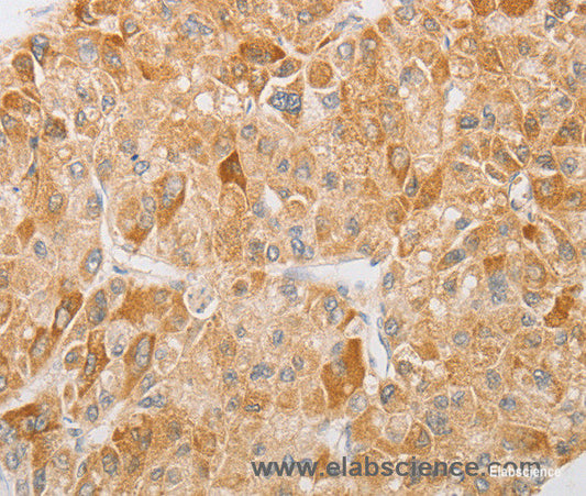 Immunohistochemistry of paraffin-embedded Human liver cancer tissue using NGF Polyclonal Antibody at dilution 1:40