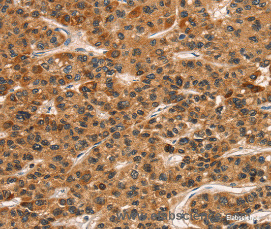 Immunohistochemistry of paraffin-embedded Human liver cancer tissue using CD159a/c Polyclonal Antibody at dilution 1:30