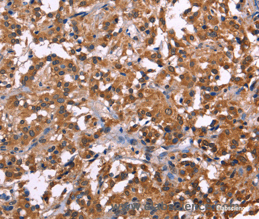 Immunohistochemistry of paraffin-embedded Human thyroid cancer tissue using NOS2 Polyclonal Antibody at dilution 1:30