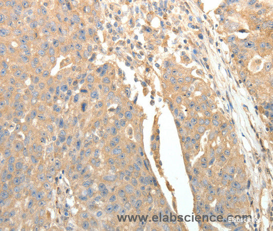 Immunohistochemistry of paraffin-embedded Human ovarian cancer tissue using SFTPD Polyclonal Antibody at dilution 1:30