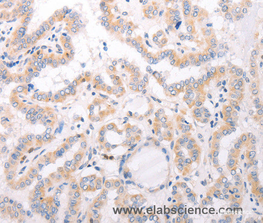 Immunohistochemistry of paraffin-embedded Human thyroid cancer tissue using CIDEB Polyclonal Antibody at dilution 1:50