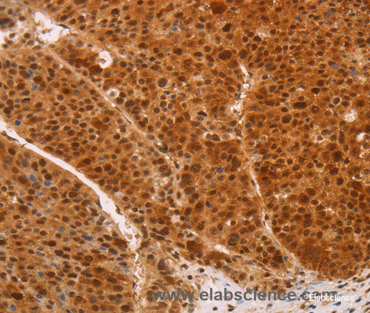 Immunohistochemistry of paraffin-embedded Human liver cancer tissue using HEXIM1 Polyclonal Antibody at dilution 1:65