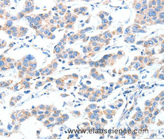 Immunohistochemistry of paraffin-embedded Human breast cancer tissue using XBP1 Polyclonal Antibody at dilution 1:70