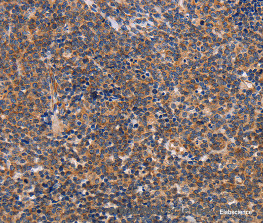 Immunohistochemistry of paraffin-embedded Human lymphoma tissue using ALG9 Polyclonal Antibody at dilution 1:30