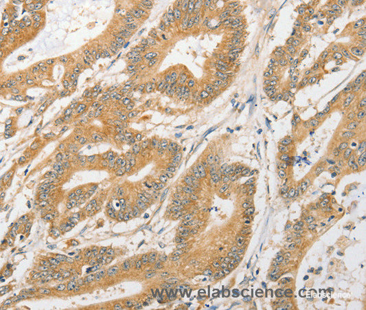 Immunohistochemistry of paraffin-embedded Human colon cancer tissue using ATG5 Polyclonal Antibody at dilution 1:40