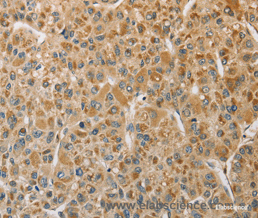 Immunohistochemistry of paraffin-embedded Human liver cancer tissue using MIP Polyclonal Antibody at dilution 1:50