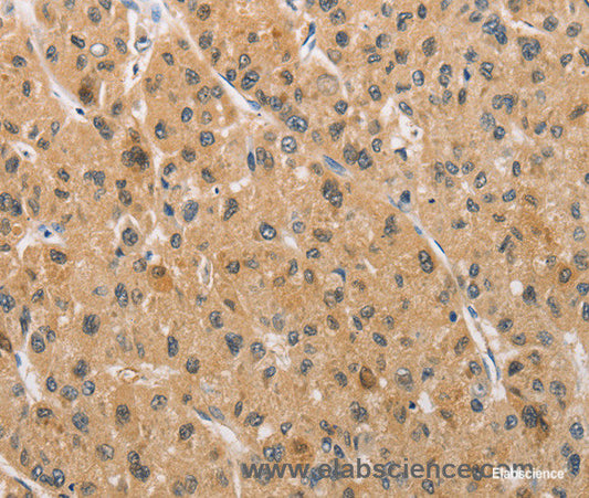 Immunohistochemistry of paraffin-embedded Human liver cancer tissue using ARMCX1 Polyclonal Antibody at dilution 1:40