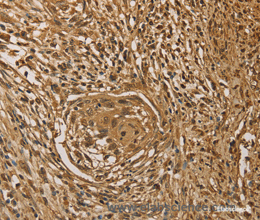Immunohistochemistry of paraffin-embedded Human cervical cancer tissue using PRDM14 Polyclonal Antibody at dilution 1:40