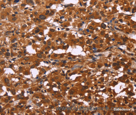 Immunohistochemistry of paraffin-embedded Human thyroid cancer tissue using ART5 Polyclonal Antibody at dilution 1:50