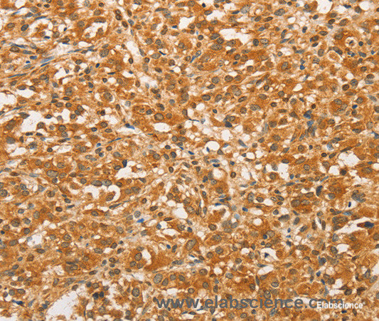 Immunohistochemistry of paraffin-embedded Human thyroid cancer tissue using BCL2L14 Polyclonal Antibody at dilution 1:40