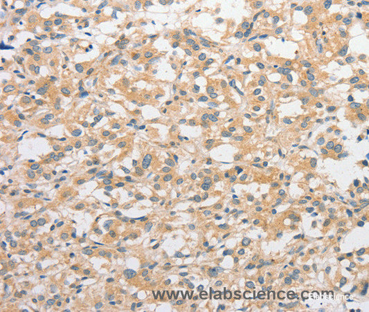 Immunohistochemistry of paraffin-embedded Human thyroid cancer tissue using CD284 Polyclonal Antibody at dilution 1:50